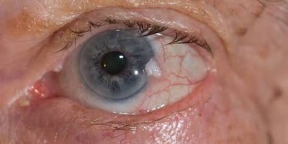 Oncología Ocular y Cáncer Periocular